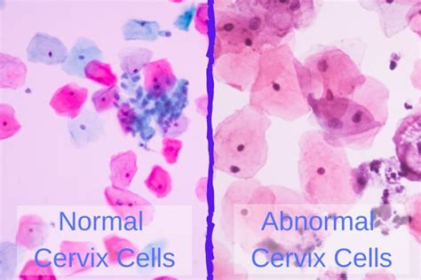 Atypical Squamous Cells Cervix