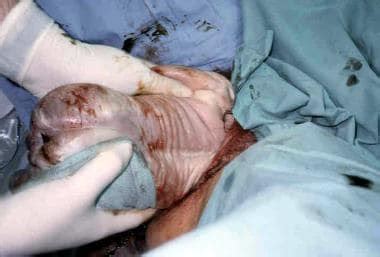 Breech Cesarean