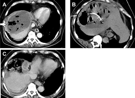Computed Tomography Ct Showed Emphysematous Subphrenic Abscess On