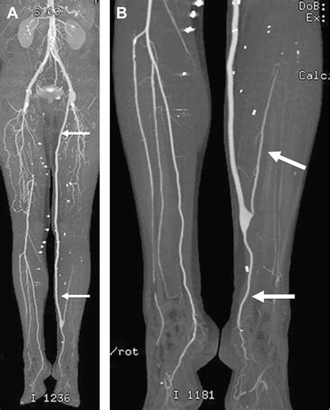 Figure 33 From Ct Angiography Of The Lower Extremities Semantic Scholar