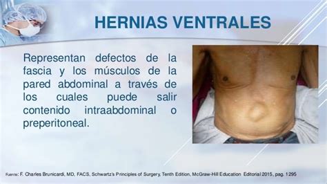 Hernias Ventrales