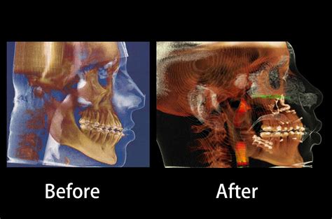 Face Nose Bite And Chin Asymmetry Correction Corrective Jaw Surgery Dr Antipov