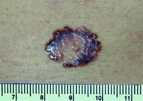 Basal Cell Carcinoma Nodular Type