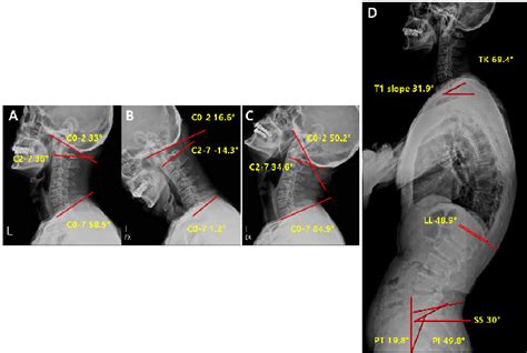 Pre Operative Radiological Parameters In Lordosis Groups Cervical