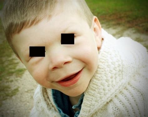 Williams Syndrome Pictures Life Expectancy Causes Symptoms