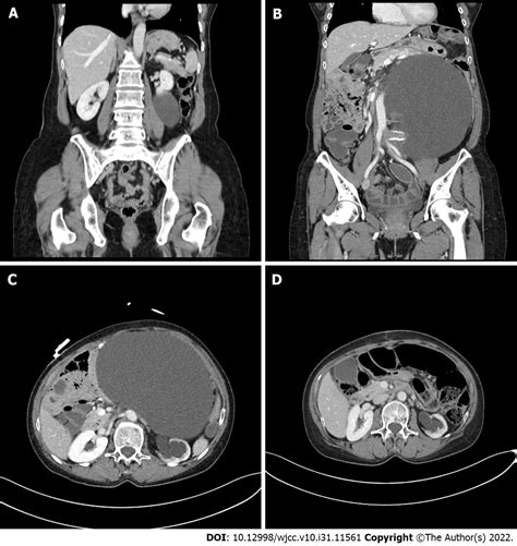 Surgical Excision Of A Large Retroperitoneal Lymphangioma A Case Report