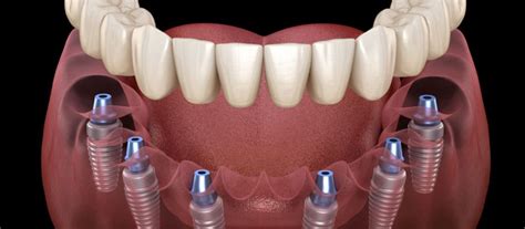 All On 6 Dental Implants Procedure Benefits Need Cost