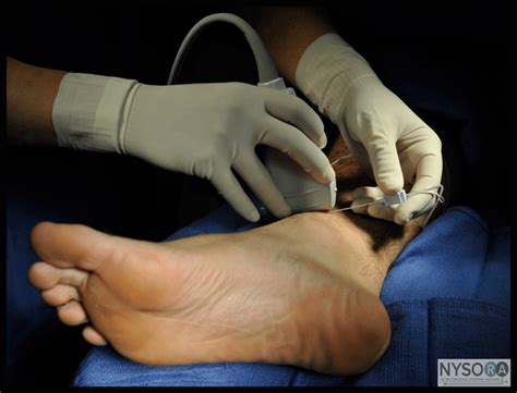 Ultrasound Guided Ankle Block Nysora The New York School Of Regional