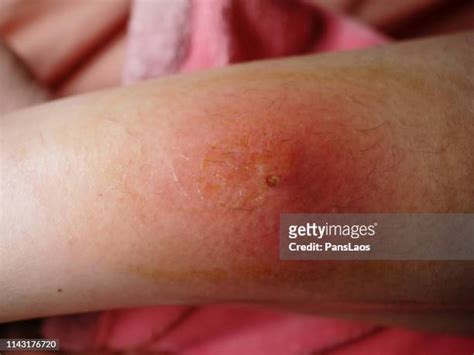 Folliculitis Legs Photos And Premium High Res Pictures Getty Images