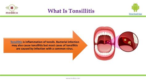 Tonsillitis Typescausessymptomsdiagnosisprevention And Treatment