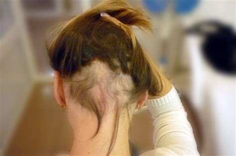Pin On Women Hair Loss Alopecia Areata Alopecia Totalis Alopecia