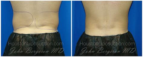 Love Handle Liposuction Houston Lipo Center This Unruly