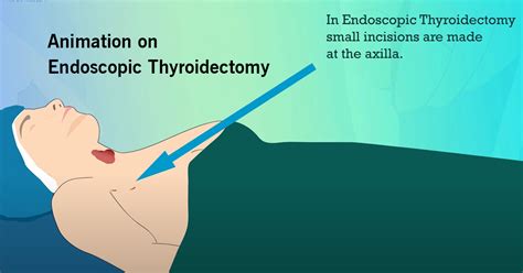 Animation On Endoscopic Thyroidectomy Dr R Padmakumar