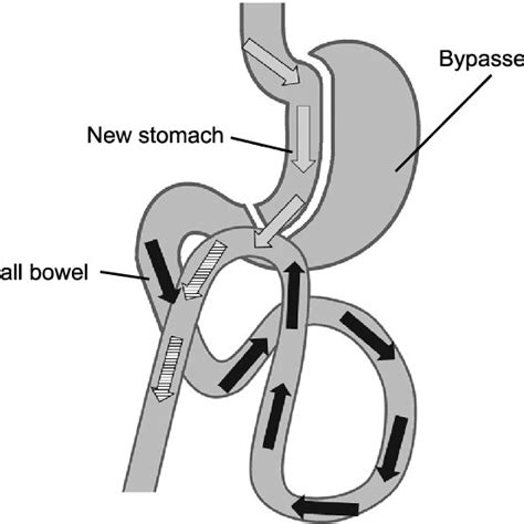 Position Of The Trocars In Laparoscopic Mini Gastric Bypass Download