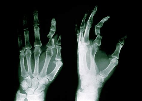X Ray Of Fractured Forefinger Phalanx Of Hand Photograph By Medical