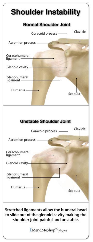 Shoulder Instability Treatments Shoulder Surgery Recovery Shoulder