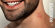 How to get rid of hickeys. | MANSCAPED™ Blog