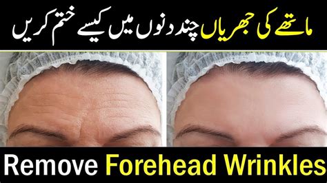 Best Forehead Wrinkle Removal Home Remedy Wrinkles On Forehead