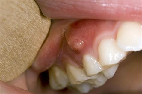 Boils On The Gums What They Are And How To Treat Them 2022