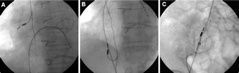 Transvenous Pacemaker Lead Extraction By Femoral Approach