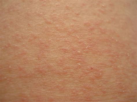 Heat Rash Itch Pictures Photos