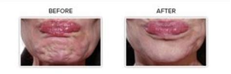 Botox Chin Clinic 1 Colchesters Leading Aesthetics Clinic