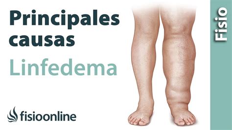 Tipos De Linfedema Y Principales Causas 🦵🏻 Youtube