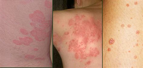 Psoriasis Types Know More About 7 Types Of Psoriasis Symptoms