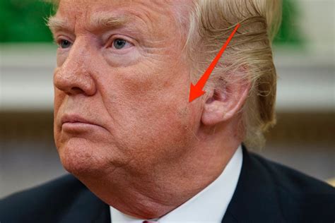 What Is That Spot On Donald Trumps Face Probably Keratosis Business