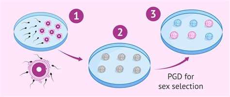 ivf with pgd for gender selection process