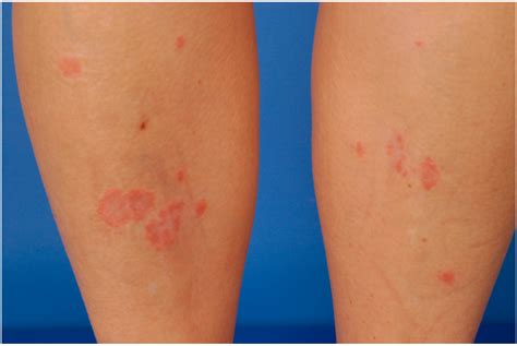 Ijms Free Full Text Cutaneous Adverse Events Associated With