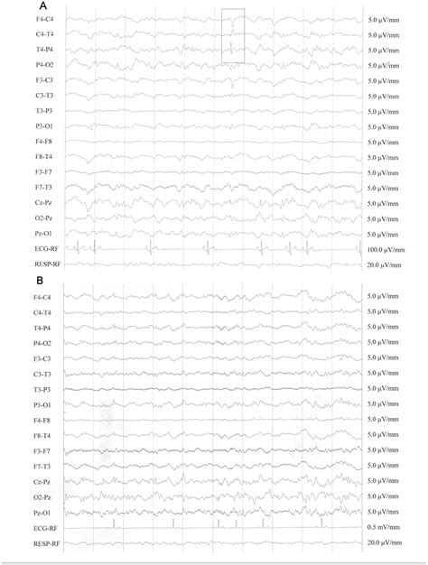 An Example Of Interictal Eeg Recording For An Epileptic A And For A