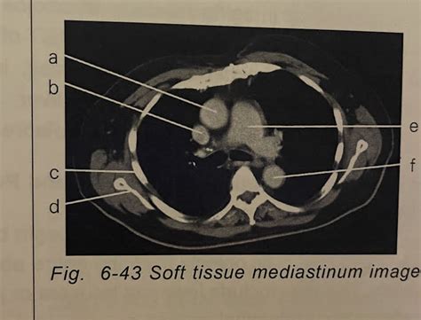 Soft Tissue Mediastinum Diagram Quizlet