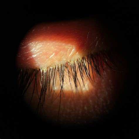 Smite The Mites How To Treat Demodex Blepharitis Review Of