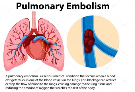 Embolia Pulmonar Con Ilustraci N Explicativa