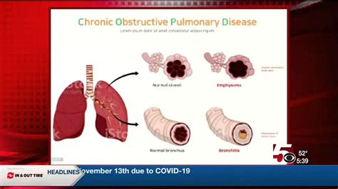 House Call Chronic Obstructive Pulmonary Disease Copd