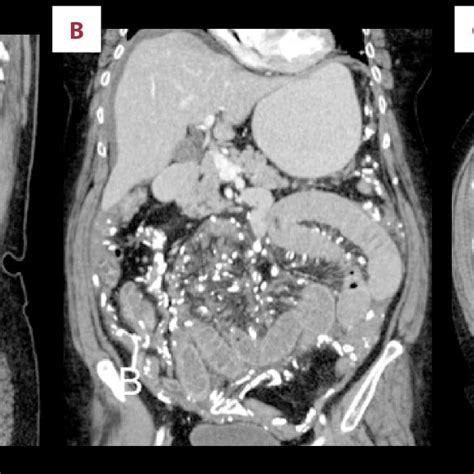 A C Computed Tomography Ct Of The Abdomen And Pelvis With Oral And