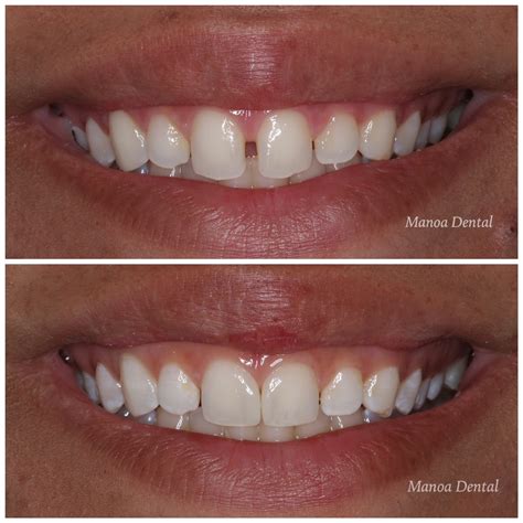 Cosmetic Bonding Gap Closure Honolulu Hawaii Oahu Manoa Dental