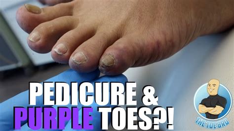 Pedicure Caused Painful Purple Pinky Toes Youtube