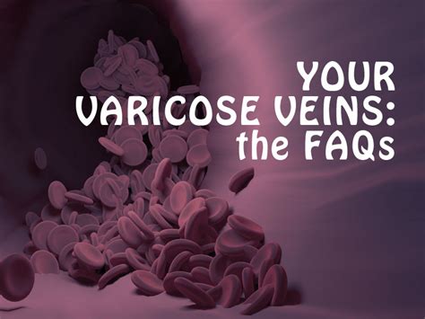 Your Varicose Veins Faqs Denver Vein Center