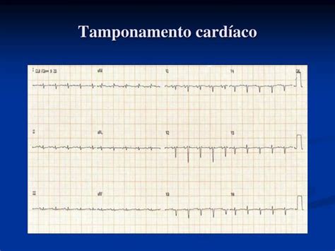 Uma das justificativas desse tipo de pulso é o aumento do retorno venoso durante a inspiração, com maior distensão do ventrículo direito, dificultando o enchimento do ventrículo. PPT - Caso Clínico: Pericardite Aguda na criança ...