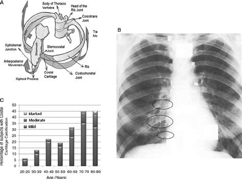 The rib cage is the arrangement of ribs attached to the vertebral column and sternum in the thorax of most vertebrates, that encloses and protects the vital organs such as the heart, lungs and great vessels. (A) Schematic diagram of the rib cage and its corresponding mechanisms... | Download Scientific ...