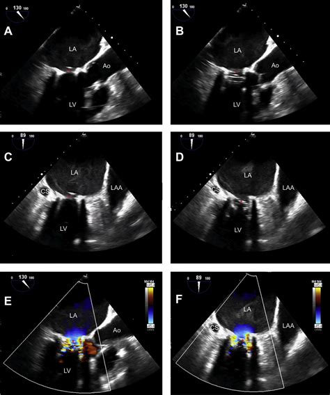 Successful Explantation Of A Ball And Cage Mitral Valve Prosthesis 48