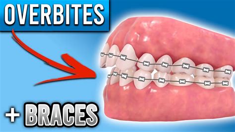 How Do Braces Fix Overbites Overbite Before And After Braces