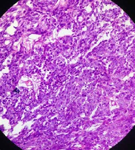 Invasive Carcinoma Nos Breast H And E 400x Tumor Cells Infiltrating