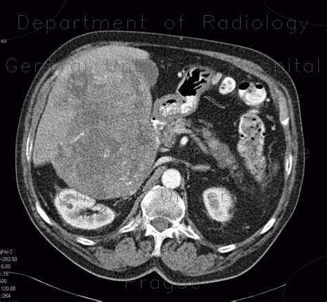 Radiology Case Hepatocellular Carcinoma Hcc