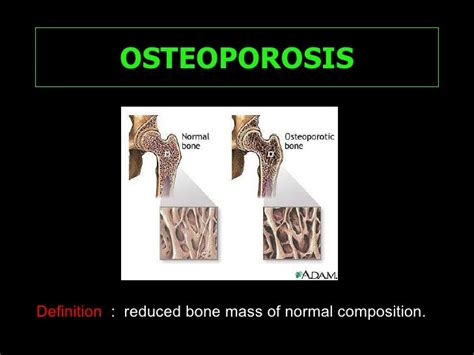 Orthopedic Aspects Of Metabolic Bone Disease By Xiu