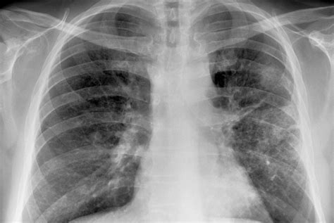 However some patients, who have an acute cardiac infarction, may still have a normal heart size, while other patients who have a large heart due to a chronic heart disease, may. Flag lung cancer risk in X-ray referrals, GPs told | GPonline