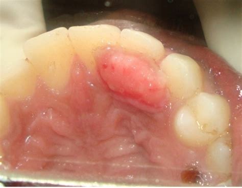 Peripheral Ossifying Fibroma Case Report