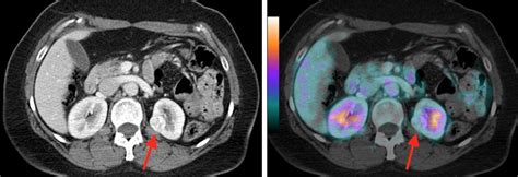 Left Image Axial Contrast Enhanced Ct Image Demonstrating A